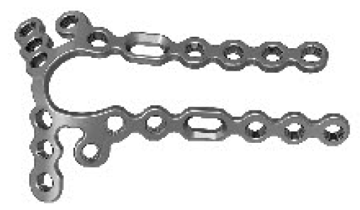 Дистальна променева блокуюча пластина по задньому краю VІІ UMP